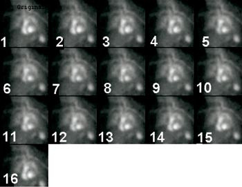 Figur 3  Isotopventrikulografi som viser variasjon gjennom 16 bilder av str&aring;leintensiteten fra venstre ventrikkel fra&hellip;