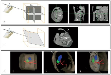 Figur 2  Navigasjonssystemets visualiseringsmetoder. a) Konvensjonell ortogonal snitting med aksialt, sagittalt og koronalt&hellip;