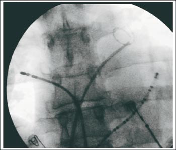Figur 2  R&oslash;ntgengjennomlysning. Oppad til h&oslash;yre i bildet ses et lassokateter i &oslash;vre venstre lungevene, nedad til h&oslash;yre et&hellip;