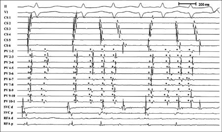 Figur 3  Registrering av overflate-EKG II og V1 og endokardiale signaler fra flere sinus coronarius-elektroder (CS 1&thinsp;&ndash;&thinsp;6) og&hellip;