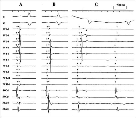 Figur 4  Isolasjon av lungevene. Under sinusrytme ses fra lassokateter i lungevenen (PV 1&thinsp;&ndash;&thinsp;10) et fjernsignal fra atriet (+&hellip;