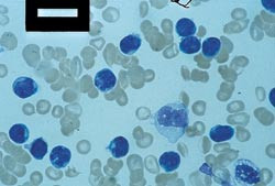 Figur 2  May-Gr&uuml;nwald-Giemsa-farget utstryk av perifert blod, som viser prolymfocytter med irregul&aelig;r kjerne med&hellip;