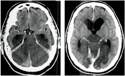 Figur 3  Cerebral CT knapt ett d&oslash;gn etter f&oslash;rste unders&oslash;kelse (fig 1) viser at det er tilkommet utbredte infarktforandringer&hellip;