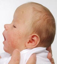 Figur 5  Muenkes syndrom. Pasienten har en relativt mild form for kompleks kraniofacial synostose, med kort og h&oslash;y skalle&hellip;