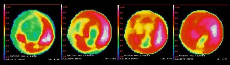 Figur 2  Myokardperfusjonsscintigram (Bull&acute;s eye-plott) hos pasient med akutt okklusjon av a. descendens anterior fra&hellip;