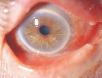 Figur 2  Akutt bakteriell konjunktivitt med moderat blandingsinjeksjon samt seigt, blakket sekret b&aring;de i &oslash;yespalten og p&aring;&hellip;