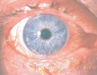 Figur 3  Moderat blandingsinjeksjon og st&oslash;rknet gult sekret p&aring; &oslash;yelokksrendene