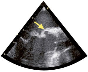 Figur 3  Trans&oslash;sofageal ekkokardiografi med et snitt som delvis tilsvarer snittet i figur 2. Innbukningen i aortaroten i&hellip;