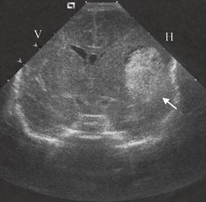 Figur 3  Cerebral ultralyd (koronalt snitt) etter f&oslash;dsel hos barn 3. En uttalt parenkymbl&oslash;dning ses i h&oslash;yre&hellip;
