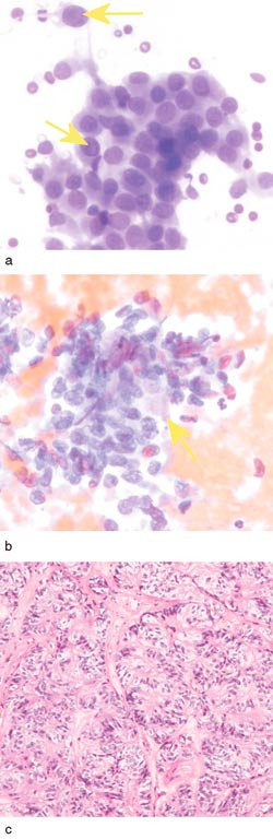 Figur 2  a) Giemsafarget cytologisk utstryk. Gule piler viser kjerneinklusjon av samme type som i figur 1a. b) Giemsafarget&hellip;