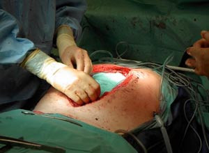 Figur 3  Det plastdekkede h&aring;ndkleet plasseres mellom bukvegg og bukorganer med den plastdekkede siden inn mot bukhulen&hellip;