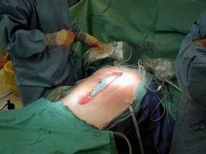 Figur 5  Vakuumdrenene kobles umiddelbart til sug eller vakuumbelger