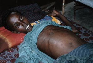 Ahmed f&oslash;r behandlingsstart. Man kan ane konturene av milten, som n&aring;r ned til navlen. Foto &Oslash;yunn Holen