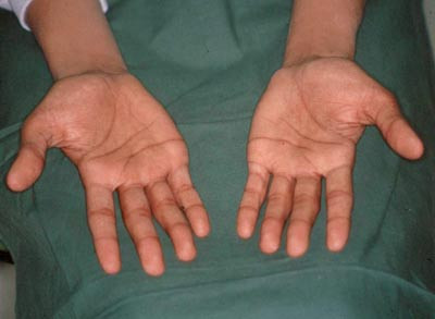 Figur 1   Typiske pigmentforandringer i hendenes b&oslash;yefurer ved Addisons sykdom