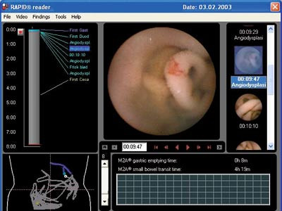 Figur 3  Skjermbilde fra dataprogrammet hvor man kan studere bildene fra tarmen. I tillegg kan funn avmerkes og lokaliseres&hellip;