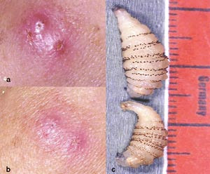 Figur 1  a, b) Furunkelliknende elementer i huden med sentral &aring;pning. c) Stadium 3 med larve sett ovenfra og fra siden. Merk&hellip;