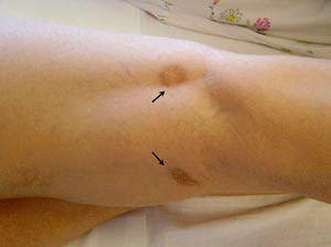 Figur 1  Hudbl&oslash;dninger i h&oslash;yre knehase som f&oslash;lge av perifere embolier