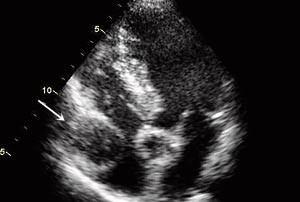 Figur 2  Bildet tatt ved transtorakal ekkokardiografi, som viser en rund patologisk struktur i h&oslash;yre atrium
