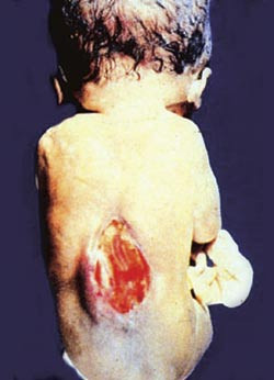 Bildet illustrerer nevralr&oslash;rsdefekt uten huddekning