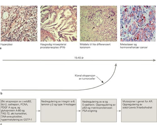 Figur 1  Patologiske og molekyl&aelig;re forandringer man i dag tror er de viktigste ved utvikling av prostatakreft. a)&hellip;