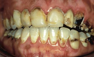 Figur 1  24-&aring;rig kvinne med munnt&oslash;rrhet og ekstrem kariesutvikling etter et halvt &aring;rs bruk av et psykofarmakum. Andre&hellip;