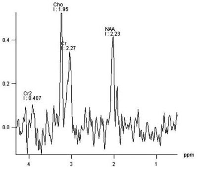 Figur 3  MR-spektroskopi fra lesjonen i venstre frontoparietalregion viser moderat forh&oslash;yet kolin- og redusert N&hellip;