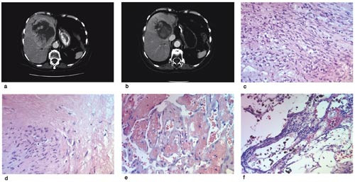 Figur 1  Radiologisk og histologisk behandlingseffekt med imatinibmesylat ved gastrointestinale stromale tumorer. Pasient 1&hellip;