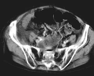 Figur 1  Computertomografiske funn ved strangulasjon: Tynntarmsdilatasjon proksimalt for stenosen