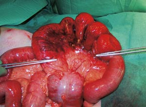 Figur 4  Hemoragiske forandringer p&aring; tynntarmsserosa for&aring;rsaket av kompromittert sirkulasjon i mesenteriet