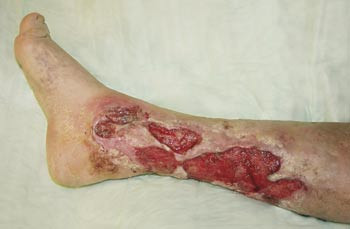 Figur 2  Multiple ven&oslash;se s&aring;r hos pasient med dyp ven&oslash;s insuffisiens