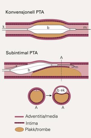 Skjematisk fremstilling av perkutan transluminal angioplastikk (PTA). &Oslash;verst konvensjonell PTA. Under vises subintimal PTA,&hellip;