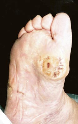 Figur 1  Diabetiske fots&aring;r som f&oslash;lge av en sensomotorisk nevropati over hodet av grunnleddet p&aring; h&oslash;yre stort&aring;. Typisk for&hellip;