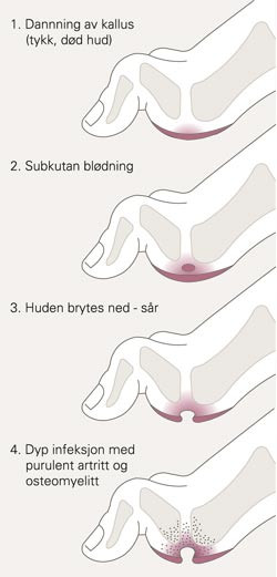 Figur 2Utvikling av sensomotoriske diabetesfots&aring;r (15)