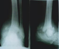 Figur 3  R&oslash;ntgenbildet av en Charcot-fot. Fotskjelettet har kollapset i mellom- og bakfoten og ankel. &Oslash;kt trykk over disse&hellip;