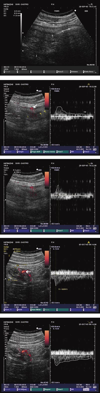 Figur 2  Pasient med akutt transitorisk h&oslash;yresidig iskemisk kolitt. a) Todimensjonal ultrasonografi av midtre transversum&hellip;
