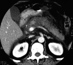 Figur 1  Kontrast-CT. Etylutl&oslash;yst akutt nekrotiserande pankreatitt. Initialfase med &oslash;dem og bl&oslash;ding. Foto Radiologisk&hellip;