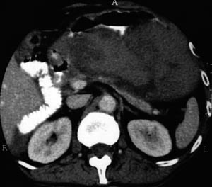 Figur 3  Kontrast-CT. Etylutl&oslash;yst akutt nekrotiserande pankreatitt. Uttalt nekrotisering &ndash; knapt noko synleg pancreasvev&hellip;