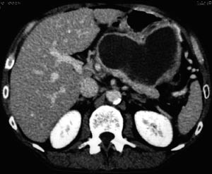 Figur 4  Kontrast-CT. Etylutl&oslash;yst akutt nekrotiserande pankreatitt. Sv&aelig;r pseudocyste ved kontroll 2&thinsp;&ndash;&thinsp;3 m&aring;nadar seinare&hellip;