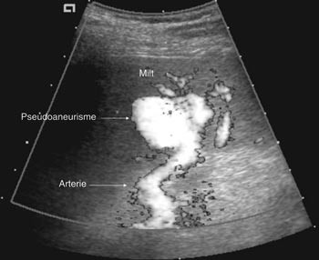 Figur 1  Ultralydbilde med doppler som viser pseudoaneurisme med tilf&oslash;rende arterie