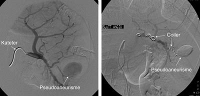 Figur 3  Miltangiogram f&oslash;r og etter embolisering av pseudoaneurisme hos pasient 1