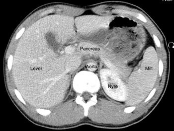 Figur 4  CT-unders&oslash;kelse av pasient 2 f&oslash;rste dag; normale funn i hilusniv&aring;