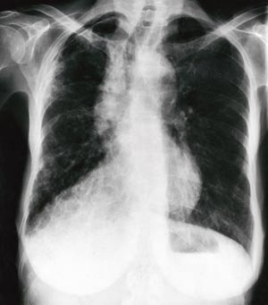 Figur 1  R&oslash;ntgen thorax viser bilaterale interstitielle lungefortetninger, hovedsakelig h&oslash;yre side med trakeal deviasjon til&hellip;