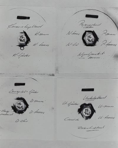 Figur 2  Dobbeldiffusjonsanalyse for presipiterende antistoffer (L. Belin, Allergilaboratoriet, Sahlgrenska sjukhuset,&hellip;