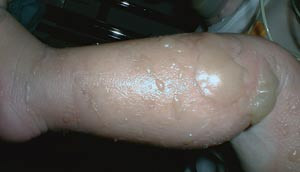 Figur 2  Annengradsskade/delhudsskade med blemmer. Venstre legg p&aring; ett &aring;r gammel gutt med skoldingsskade. Foto Guro Vaagb&oslash;,&hellip;