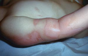 Figur 3  Annengradsskade/delhudsskade hvor blemmene er fjernet. Skoldingsskade i albueregionen p&aring; tre &aring;r gammel pike. Foto&hellip;