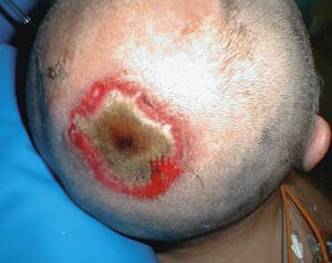 Figur 4  Tredjegradsskade/fullhudsskade. Bakhodet p&aring; voksen mann med h&oslash;yvoltskade. Foto Guro Vaagb&oslash;, Brannskadeavsnittet