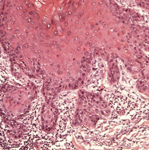 Figur 4  H&oslash;yt differensiert plateepitelkarsinom med tydelig infiltrasjon i bindevev
