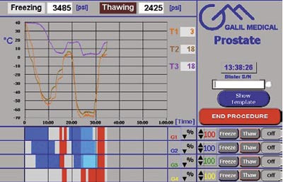 Figur 1  Skjermbilde fra kryomaskin som viser temperaturkurver under behandlingen fra sensorer plassert i hver&hellip;