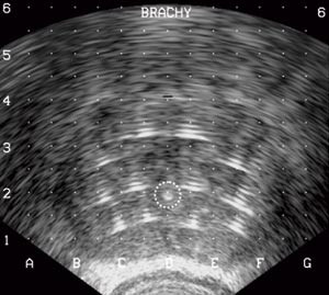 Figur 3  Sonografisk tverrsnitt av prostata etter at frysen&aring;lene er plassert. Urethra er markert med en stiplet ring&hellip;