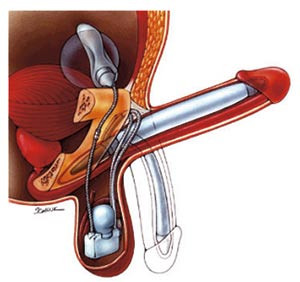 Figur 1  Skjematisk fremstilling av penisimplantatet. Figuren er gjengitt med tillatelse fra AMS 700TM Penile Prothesis, www&hellip;
